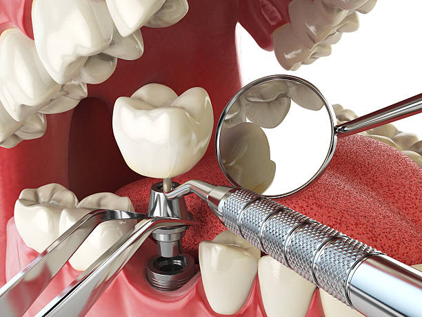 Best Emergency Tooth Extraction in University At Buffalo, NY